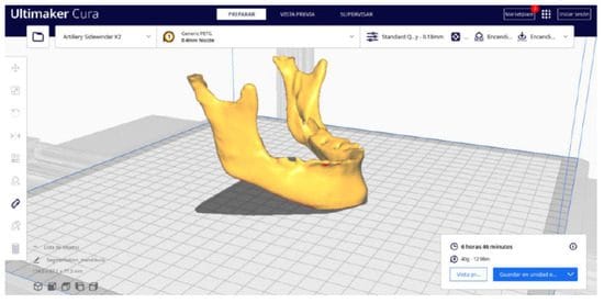 Mandíbula impresa 3d- Protocolo hospital